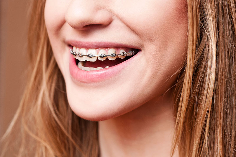 Orthodontics - Douglas Dental Center, Waukegan Dentist