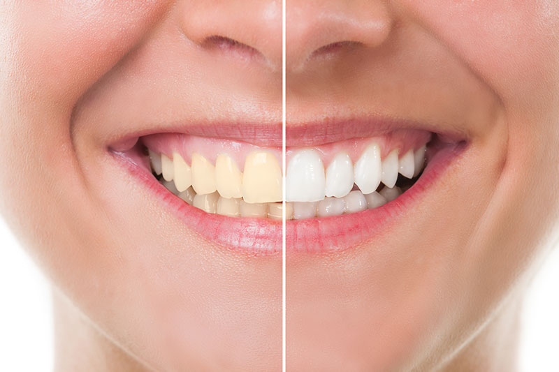 Teeth Whitening - Douglas Dental Center, Waukegan Dentist